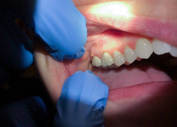 Best Dentist for Tooth Abscess  in Kaser, NY